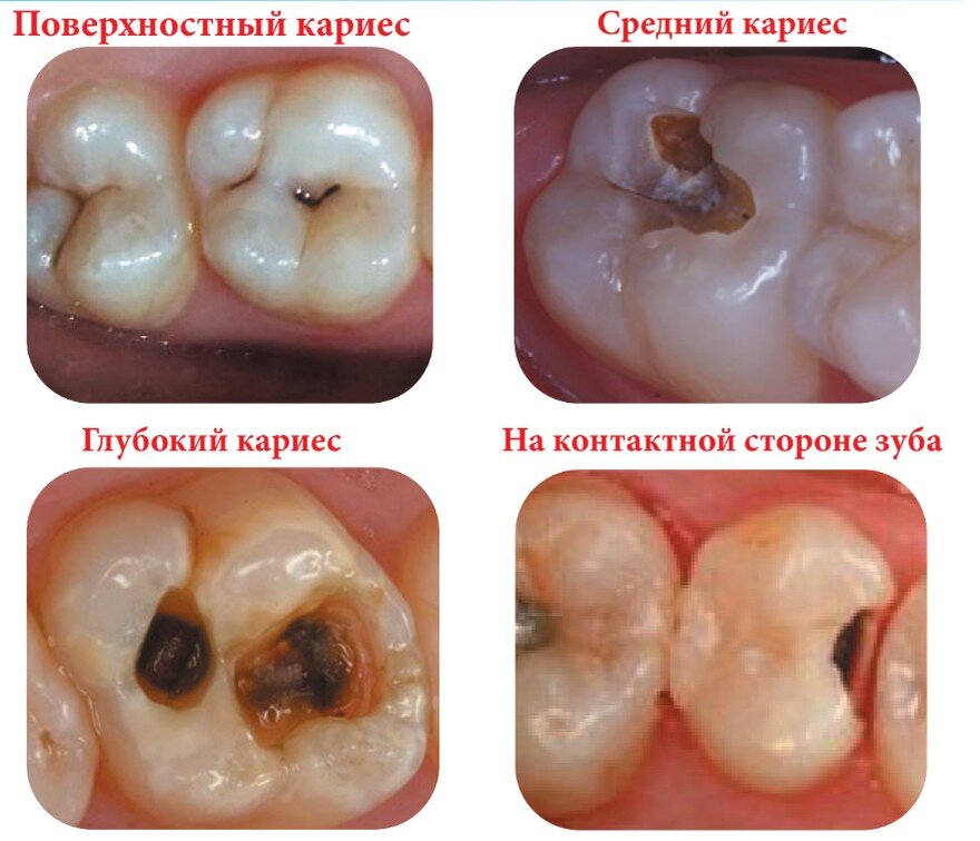  Различные виды кариозного процесса на боковых зубах: поверхностный, средний, глубокий, на контактной стороне зуба