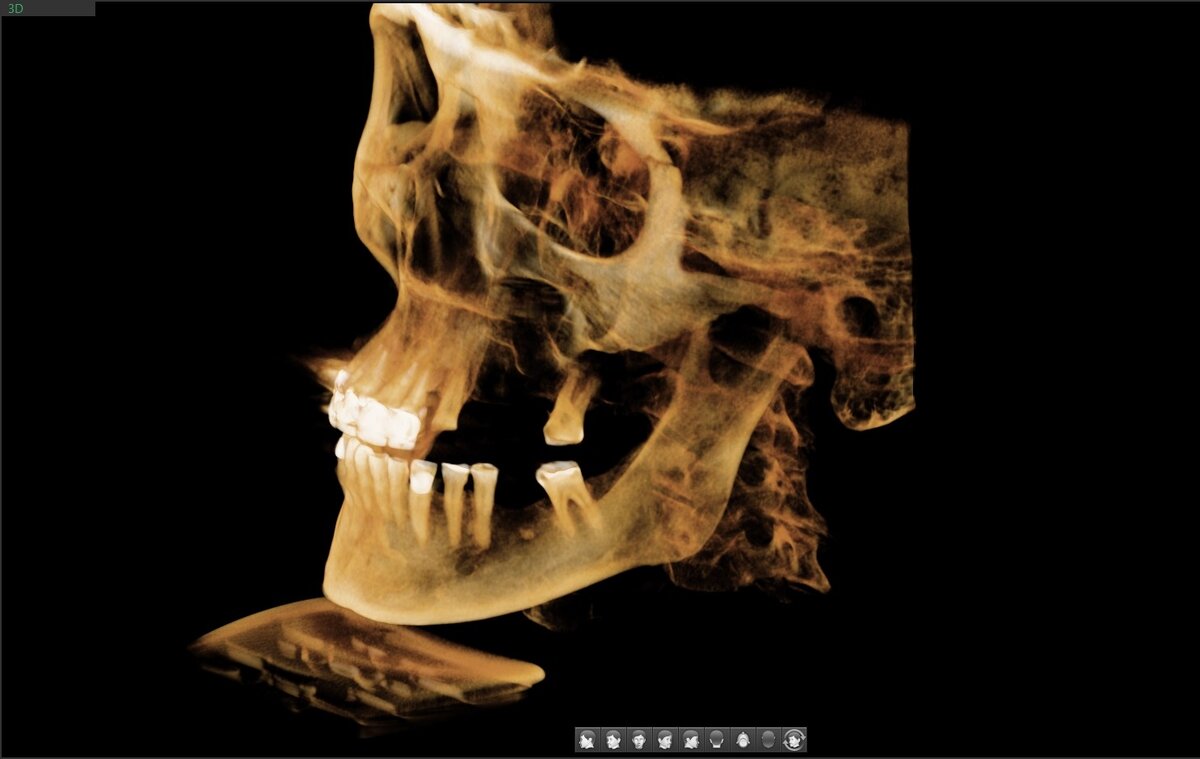 3Д визуализация лицевого скелета. Левая сторона.