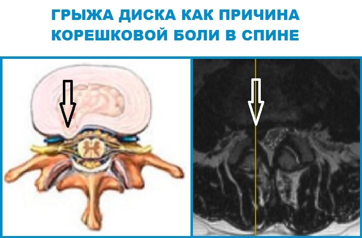 Лечение грыжи l4 l5. Дегенеративные изменения позвоночника. Спинная боль. МЕДХАУС форум о позвоночнике.