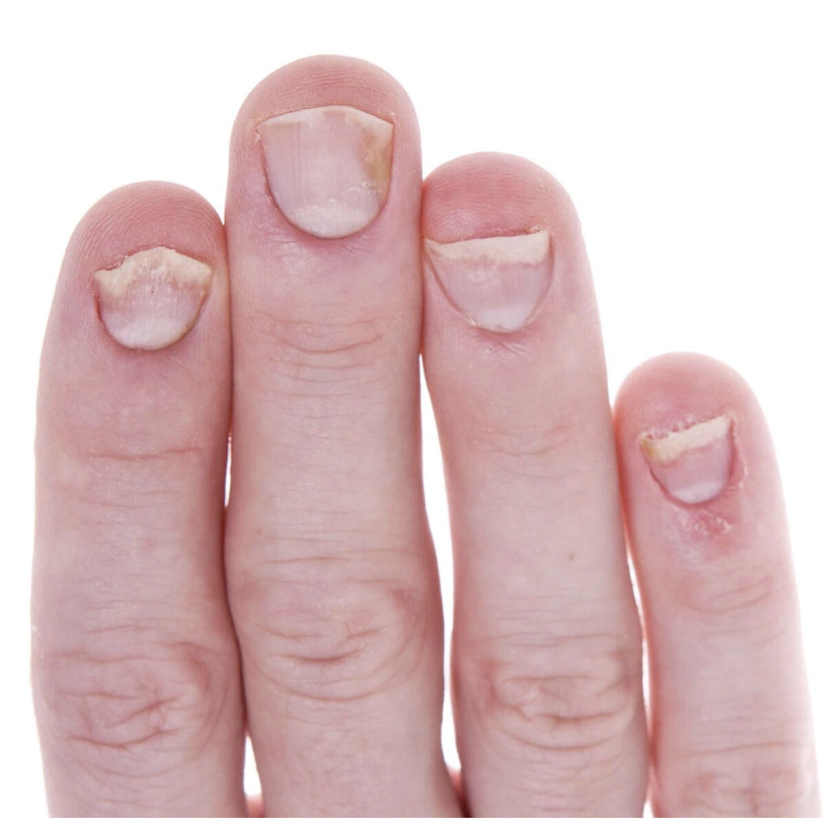 Ломает ногти на руках. Ломает ногти на руках. Ломает ногти на руках. Тонкие ногти. Ломает ногти на руках.