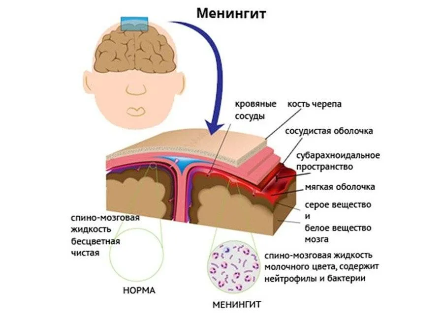 Менингококковая инфекция симптомы фото