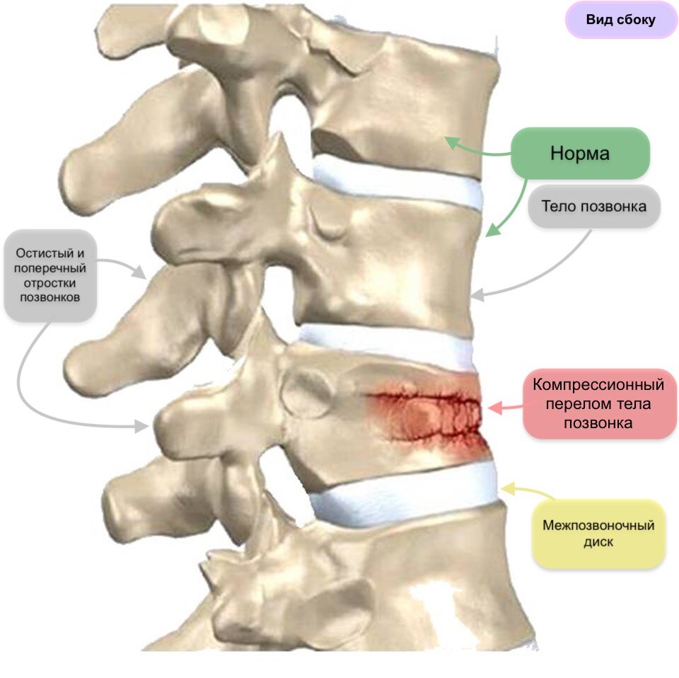 Компрессионный перелом позвоночника у детей | Со слов Детского Хирурга |  Дзен