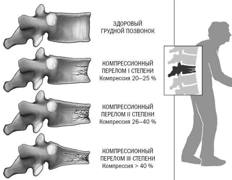Перелом спины. Компрессионный перелом позвонка степени компрессии. Компрессионный перелом позвоночника т6. Компрессионный перелом позвоночника 1 степени. Компрессионный перелом l1 позвонка 1 степени