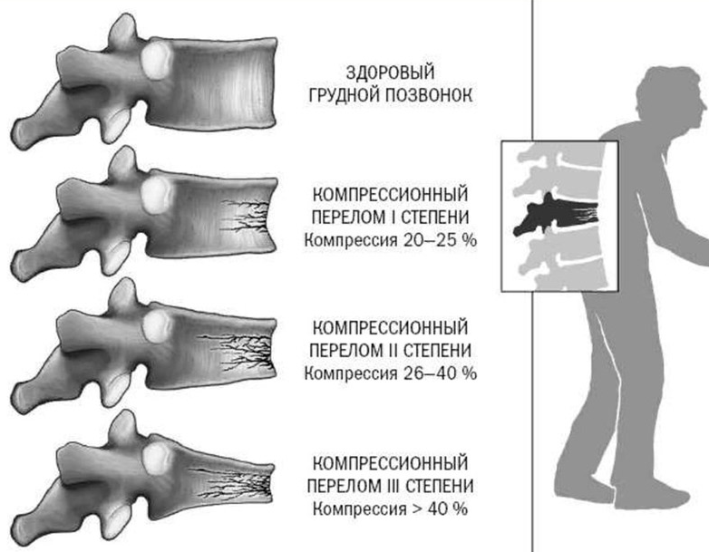 Что такое компрессионный перелом позвоночника. Компрессионный перелом позвонка степени компрессии. Компрессионный перелом позвоночника т6. Компрессионный перелом позвоночника 1 степени. Компрессионный перелом l1 позвонка 1 степени.