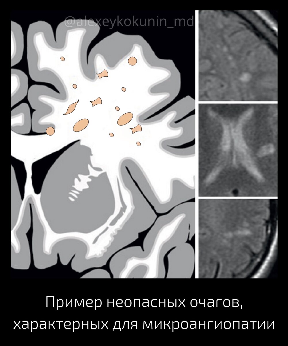 Очаговые поражения белого вещества головного мозга