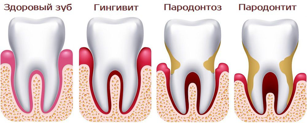 Состояние тканей пародонта. Пародонтоз патанатомия. Пародонтит и пародонтоз. Гингивит пародонтит пародонтоз. Периодонтит пародонтит различия.