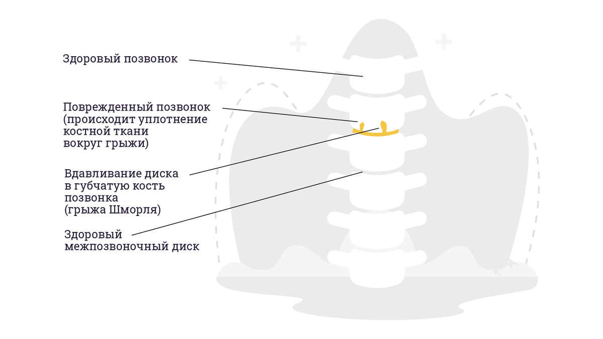 Берут ли в армию с атопическим дерматитом? | ПризываНет | Дзен