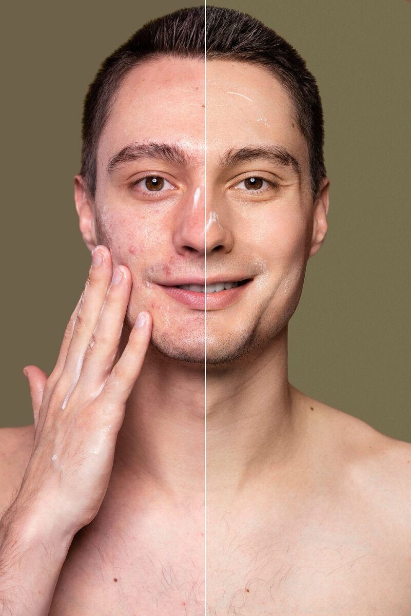 Изображение от <a href="https://ru.freepik.com/free-photo/before-and-after-portrait-of-young-man-retouched_18962253.htm#page=4&query=%D0%B0%D0%BA%D0%BD%D0%B5&position=32&from_view=search&track=sph">Freepik</a>