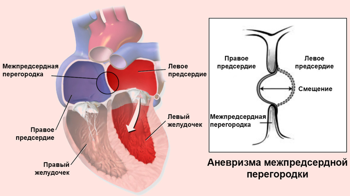 Аневризма сердца что это такое симптомы. Аневризма межсердечной перегородки. Элонгация межпредсердной перегородки. Межпредсердная перегородка аневризма. Межпредсердная перегородка сердца порок.