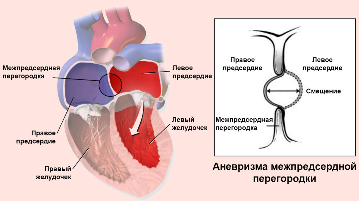 Аневризма межпредсердной перегородки у взрослых. Незаращение межпредсердной перегородки. элонгация межпредсердной перегородки. межпредсердная перегородка аневризма. межпредсердная перегородка сердца порок.