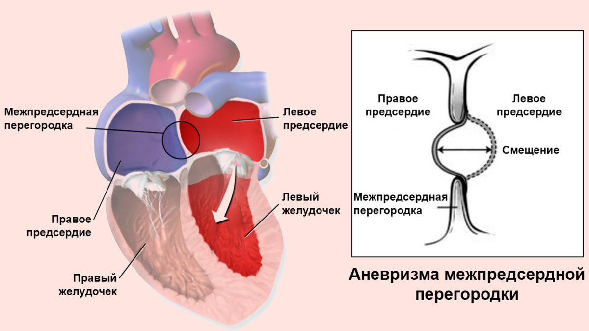 Аневризма сердца опасно. Аневризма межсердечной перегородки. Элонгация межпредсердной перегородки. Межпредсердная перегородка аневризма. Типы аневризмы межпредсердной перегородки.