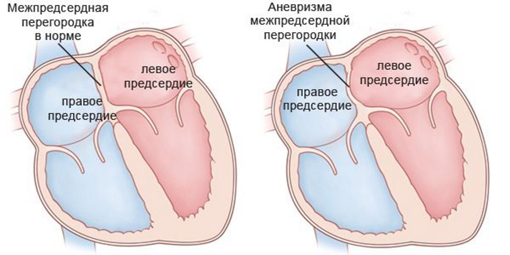 Синонимы аневризмы межпредсердной перегородки