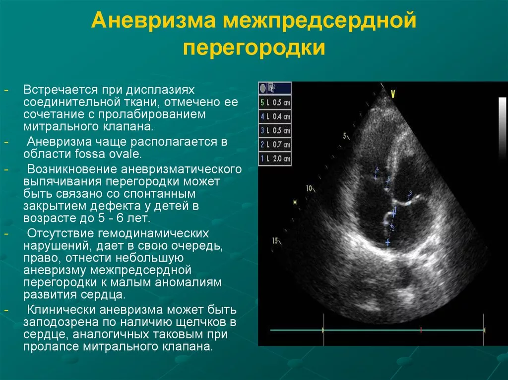 Аневризма мпп. Аневризма МПП на ЭХОКГ. Эхокардиография аневризма МПП. Аневризматическое выпячивание МПП. УЗИ сердца, аневризма межпредсердной перегородки.