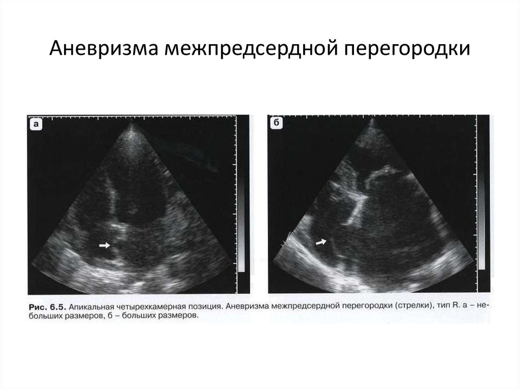 Аневризма межпредсердной перегородки. Эхокардиография аневризма МПП. Аневризма МПП на ЭХОКГ. Аневризматическое расширение межпредсердной перегородки. УЗИ сердца, аневризма межпредсердной перегородки.