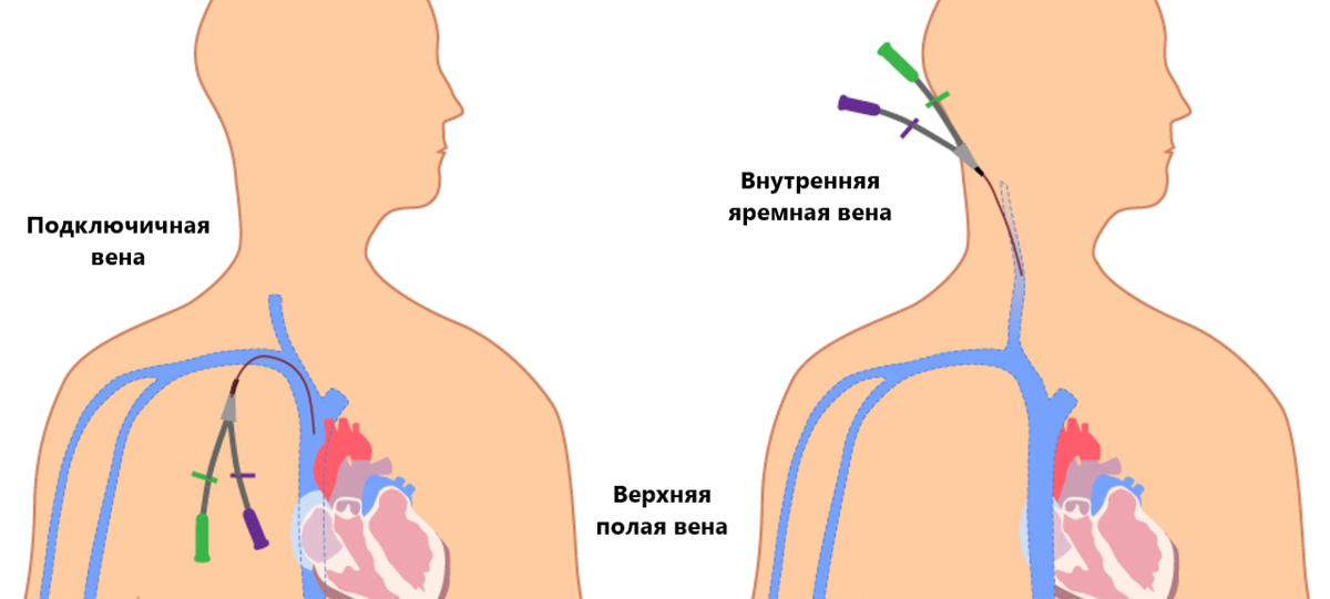 Катетер в яремной вене. Центральный венозный катетер подключичный. Центральный венозный катетер осложнения. ЦВК Центральный венозный катетер. Туннельный Центральный венозный катетер.