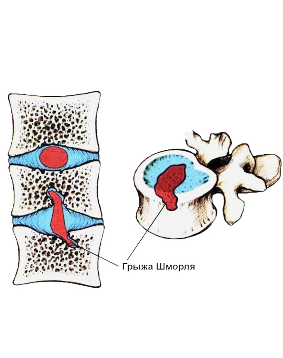 Узлы шморля в позвоночнике