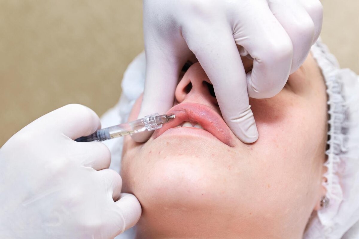 Доктор ост укол отзывы. Lip Filler Injection. Укол филлера в связки.