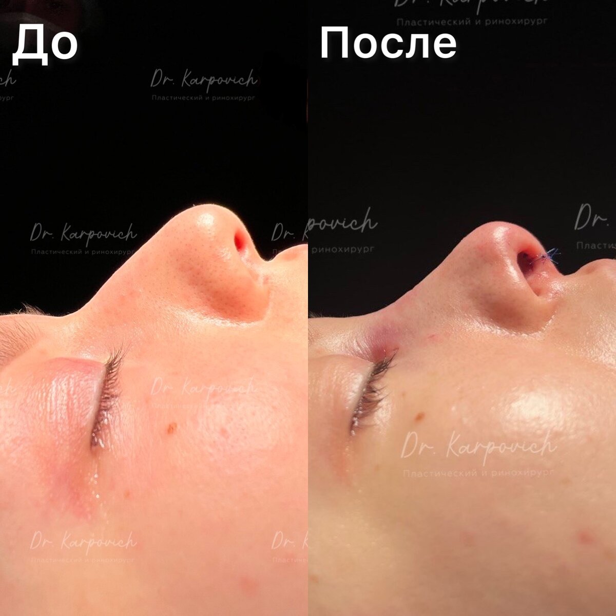 Выполнили операцию 3 в 1 за один наркоз ! Исправили девушке горбинку, кончик носа, устранили гайморит и улучшили носовое дыхание.