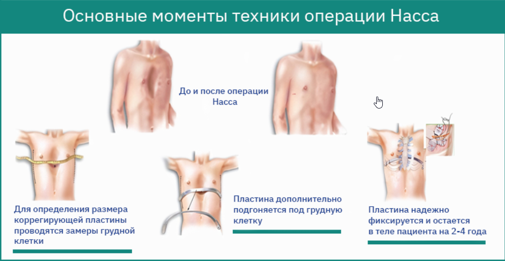 Воронкообразная грудная клетка