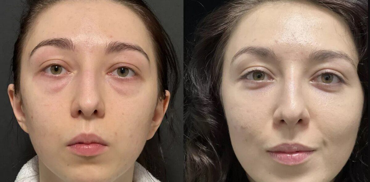 Проведена трансконъюктивальная блефаропластика с частичным иссечением грыж и липофилинг нижнего века. Фото до и после. Фото с сайта Д.Р. Гришкяна. Имеются противопоказания, требуется консультация специалистов