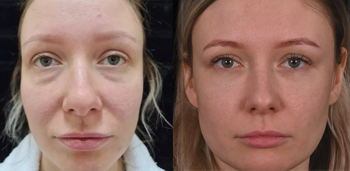 Провели липофилинг средней зоны включая нижние веки, затем через внутренний разрез (конъюнктиву) немного скорректировали грыжи. Фото до и после. Фото с сайта Д.Р. Гришкяна. Имеются противопоказания, требуется консультация специалистов