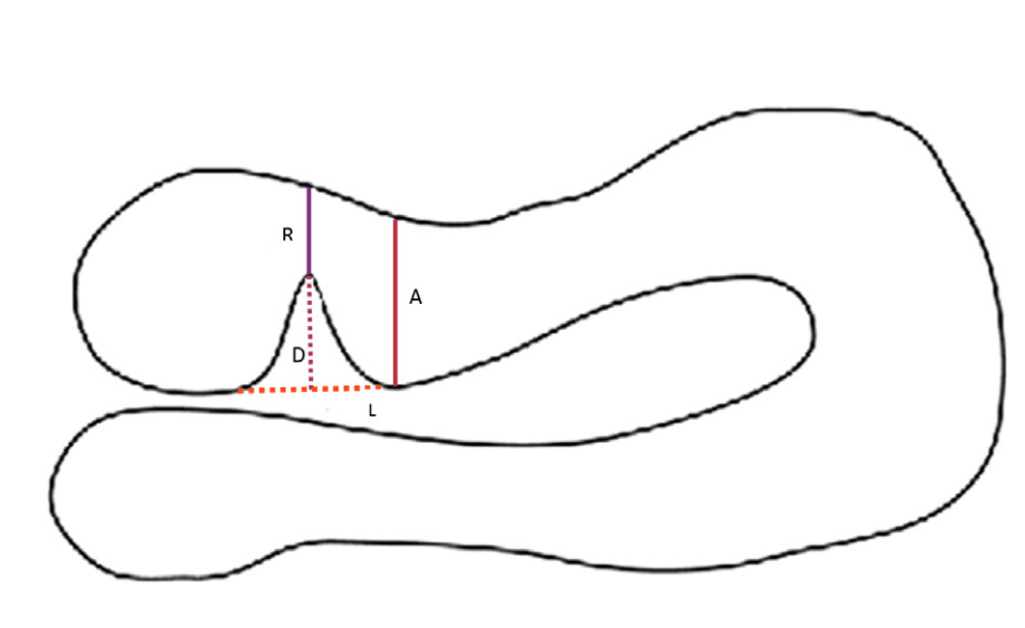 РИСУНОК 1. Размеры ниши для двумерного трансвагинального УЗИ матки. Измерение ниши матки проводили в сагиттальной плоскости для измерения длины у основания (L), глубины основания по отношению к миометрию (D), остаточной толщины миометрия (R) над областью дефицита и  толщина прилегающего  миометрия (А) на участке с полной толщиной миометрия, около  ниши. По поперечной плоскости оценивали наибольшую ширину ниши.