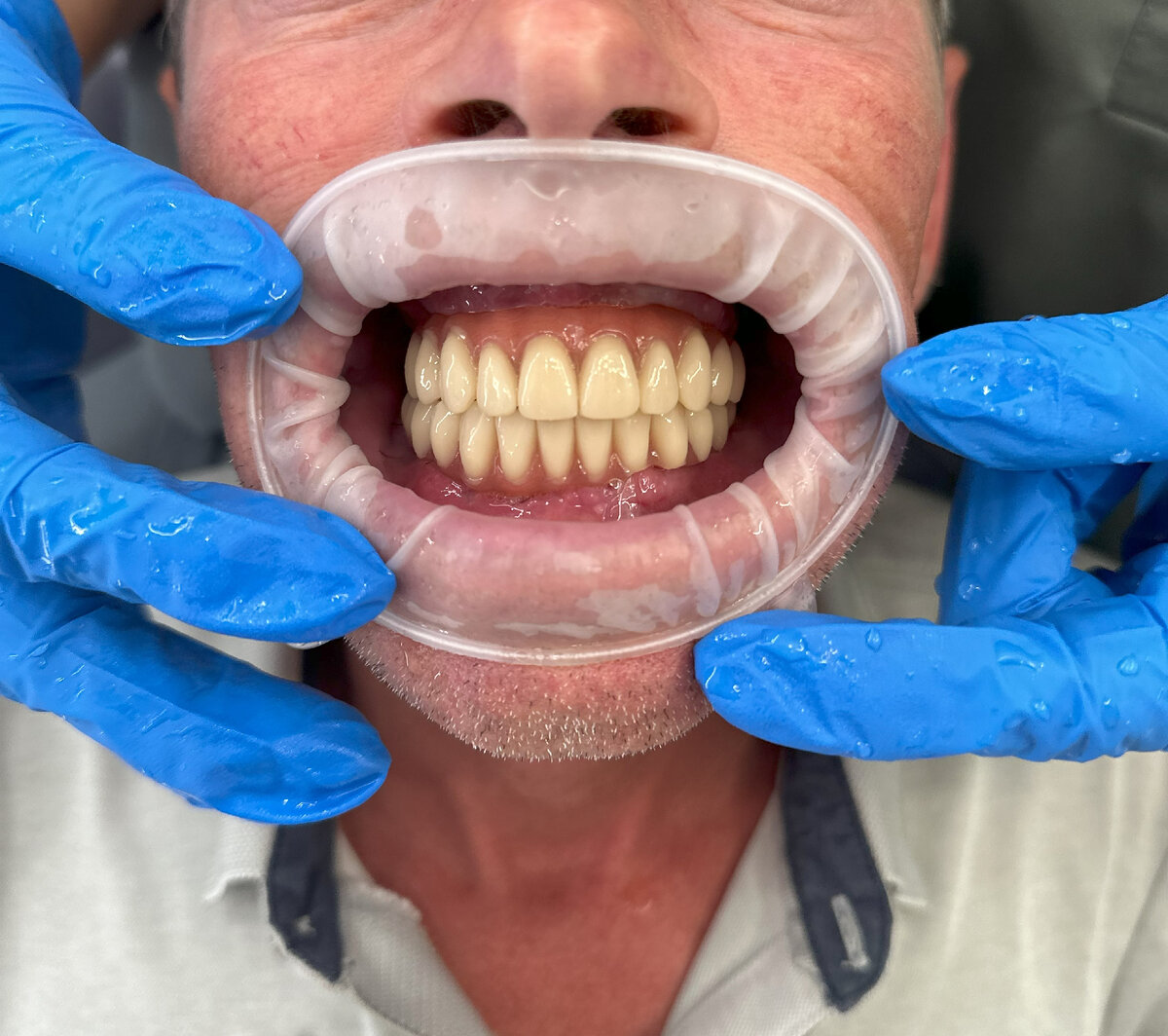 Протезы с розовой десной. Вариант - временный, но уже не примерочный. С ним человеку жить около года.