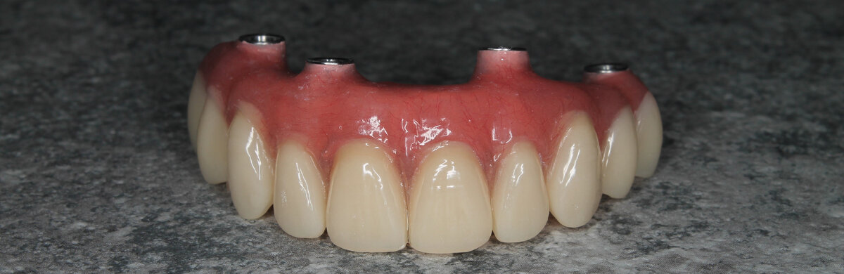 Много розовой десны.