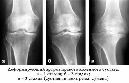 Рентген коленного сустава с нагрузкой
