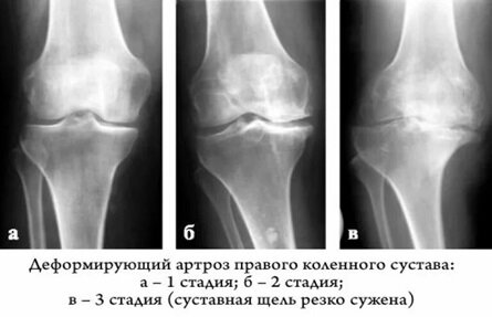 Гонартроз: лечение в Израиле