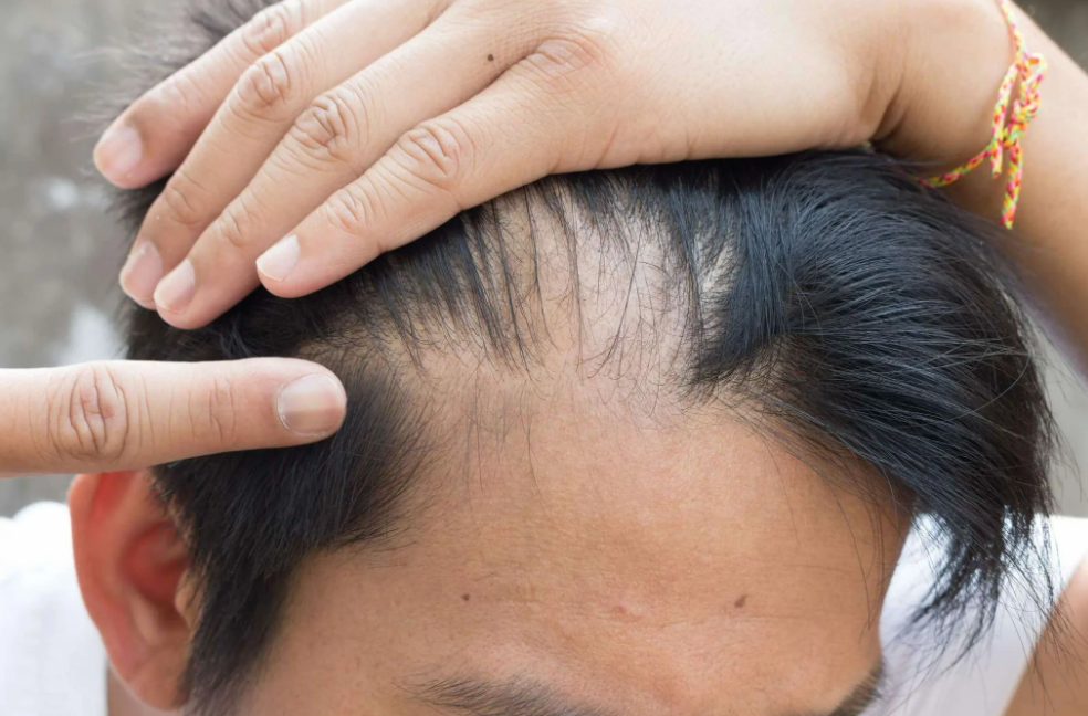 Выпадение волос после коронавируса