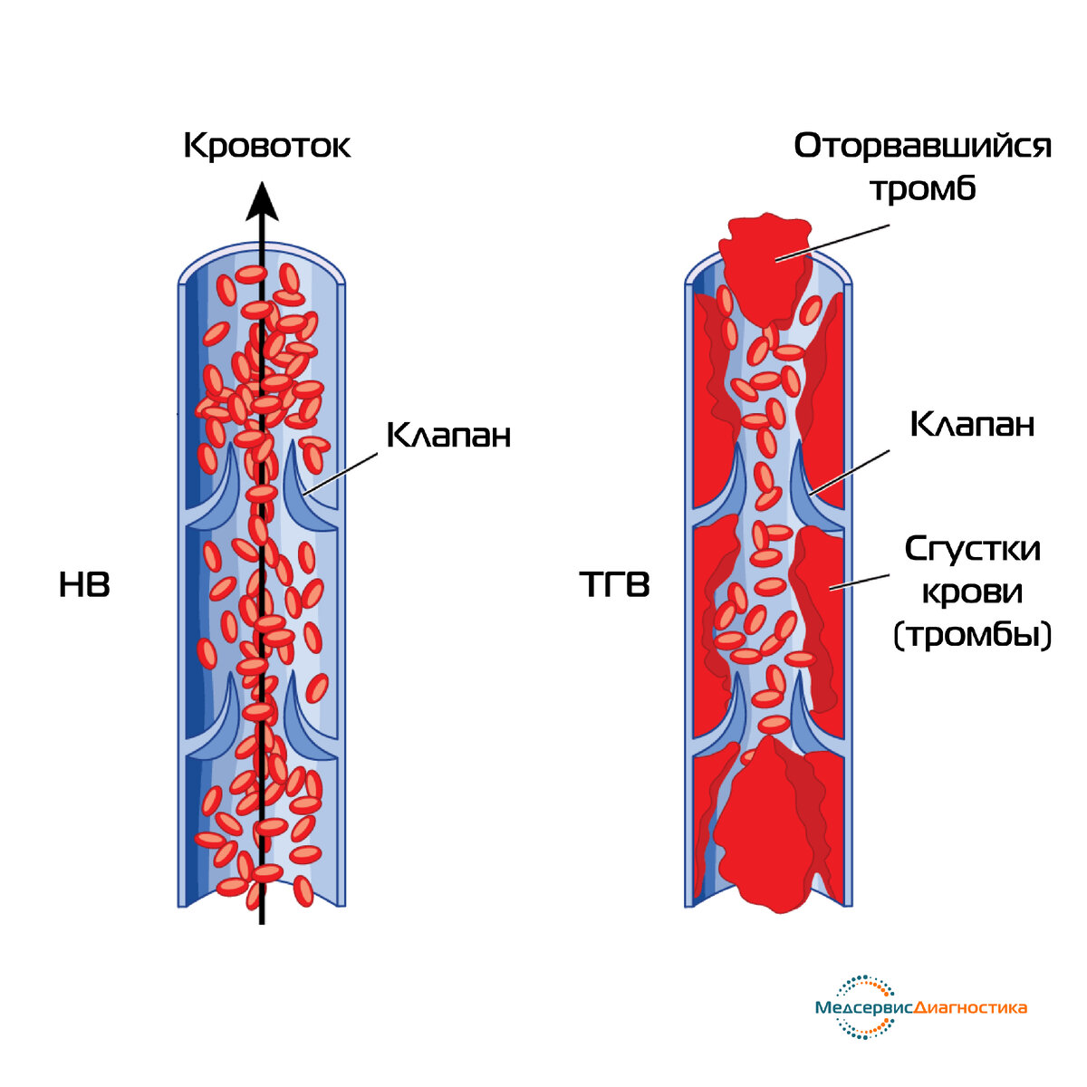 Тромбоз глубоких вен (ТГВ)