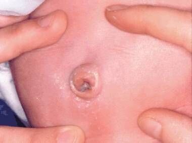 Простой омфалит. 