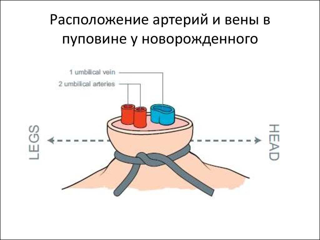 Омфалит у детей и взрослых