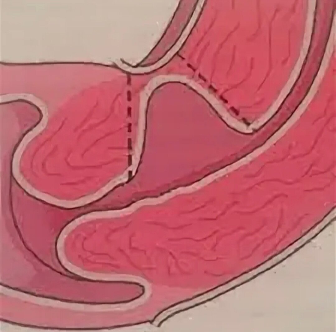 Так выглядит ниша в области рубца