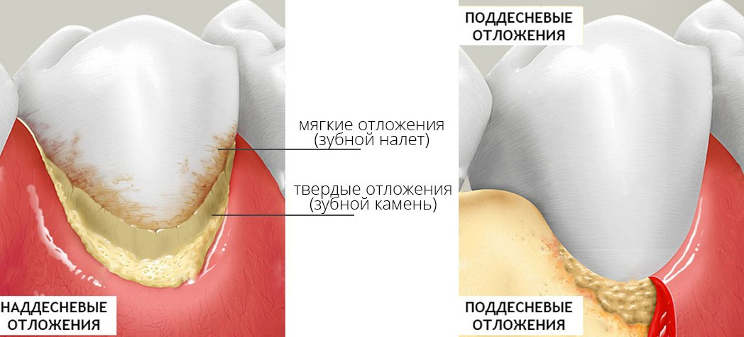 Почему кровоточат десны при чистке зубов