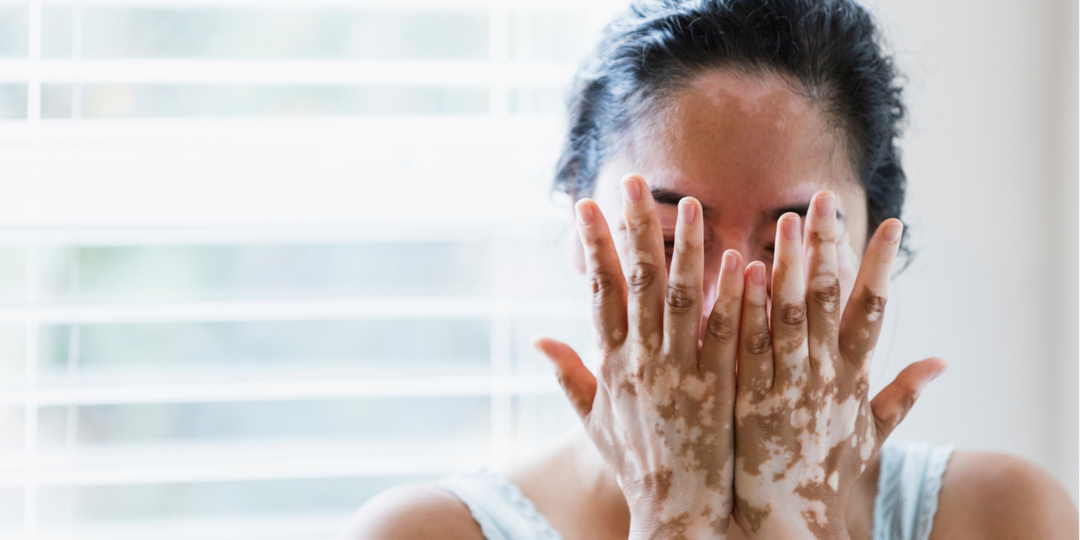 Витилиго: взгляд на патологию и способы коррекции