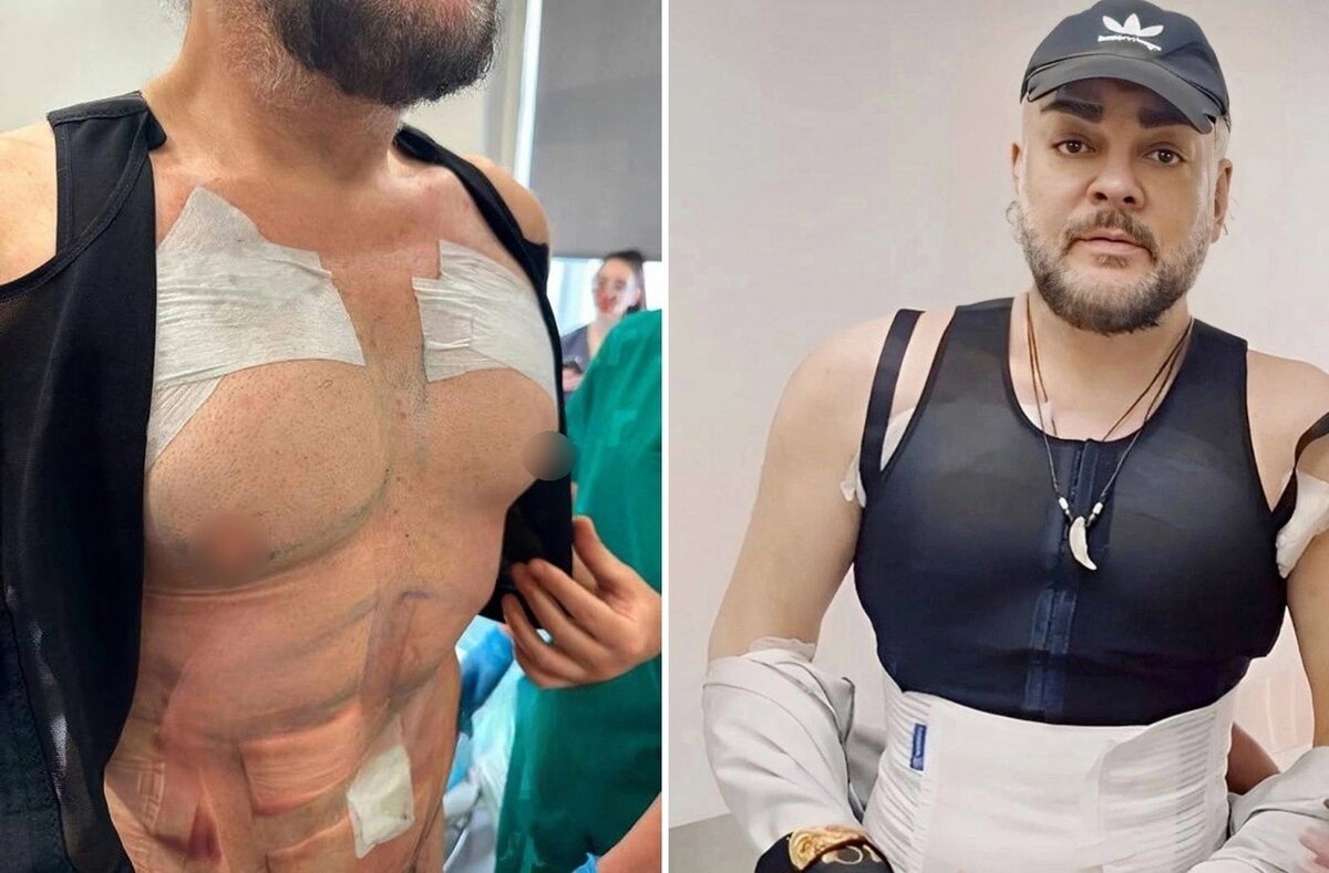 чумаков фото до и после операции