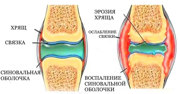 Синовит коленного сустава - лечение и симптомы, диагностика | Клиника доктора Длина
