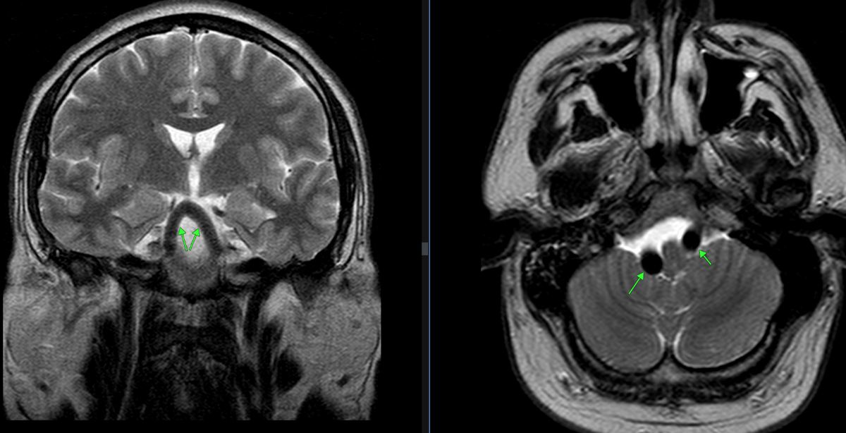 Рис. 1. Определяется выраженное расширение интракраниальных отделов позвоночных артерий, диаметром справа до 10 мм, слева до 8-9 мм (норма до 3.8 мм), с компримированием ствола мозга.