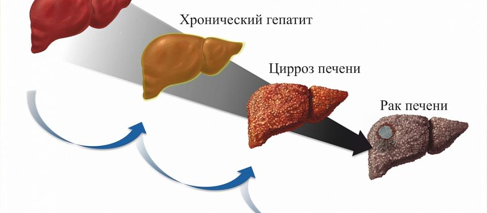 Цирроз печени при гепатите c. Хронический гепатит и цирроз печени. Цероз печень гепатит б. Цирроз печени патология. Печень больного гепатитом с.