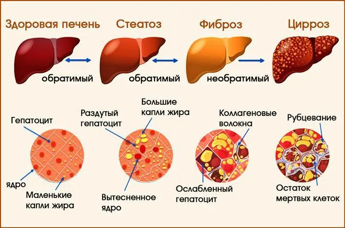 При портальном циррозе печени на первый план выступает