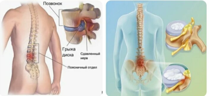 Прострелы в пояснице причины лечение. Защемление нерва в пояснице. Как укрепить позвоночник.