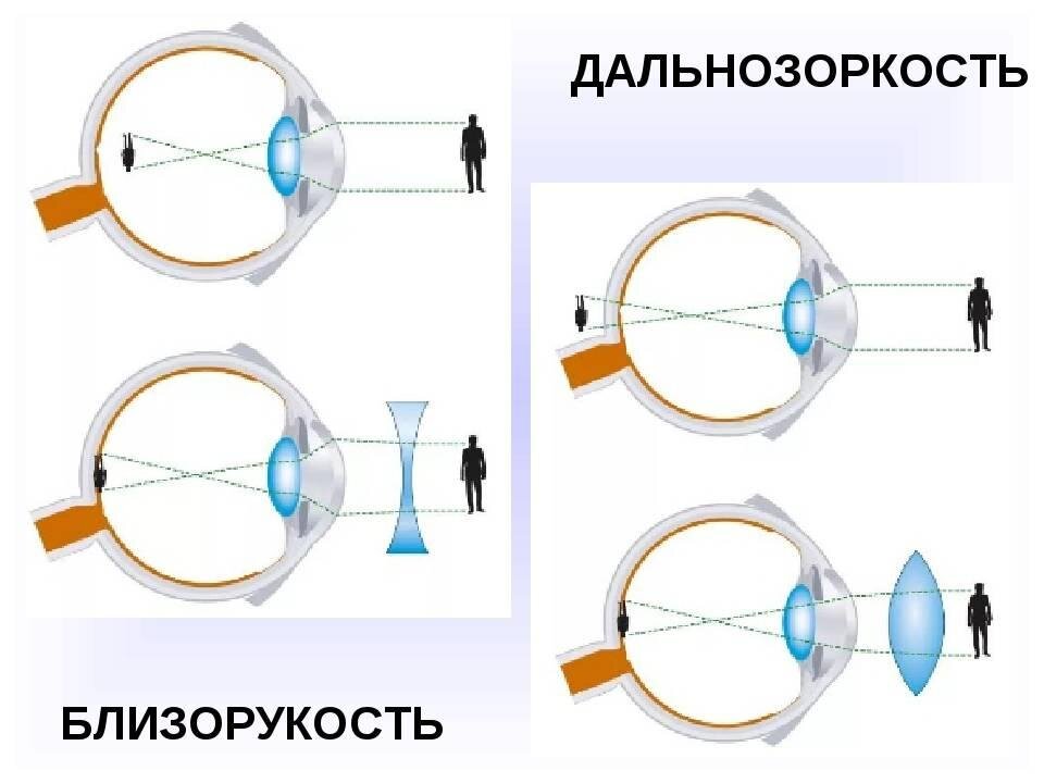 Близорукость. Дальнозоркость