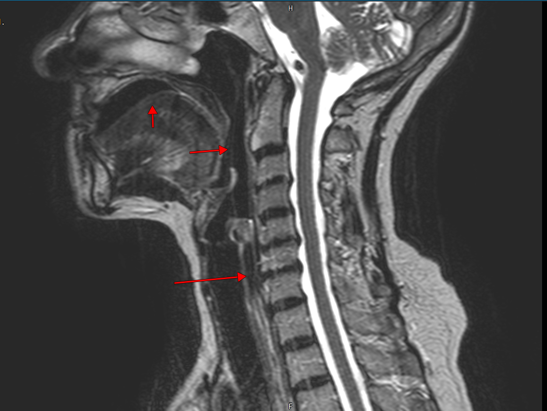 МРТ мягких тканей шеи. Разбор клинического случая. | D2D Expert | Дзен