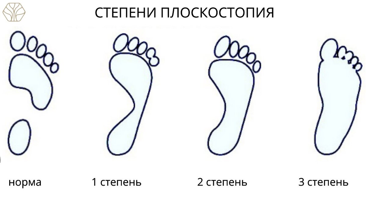 Как выглядит плоскостопие у ребенка 2 лет Комплекс упражнений для лечения плоскостопия. Психология отношений
