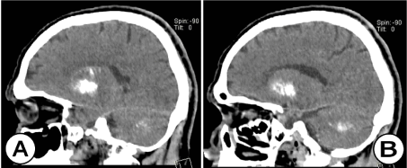 Рис. 6. Нативная КТ головного мозга (сагиттальная плоскость) (А) и (В): участки  кальцификации с вовлечением зубчатых ядер и гемисфер мозжечка, а также  базальных ганглиев (хвостатое ядро, бледный шар, чечевицеобразное ядро ​​и скорлупа) у того же пациента.