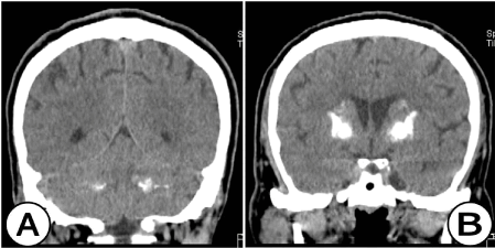 Рис. 5. Нативная КТ  головного мозга (корональная плоскость). (А) На уровне задней черепной ямки отчетливо видны двусторонние, высокоплотные и обширные участки кальцификации с вовлечением зубчатых ядер и гемисфер мозжечка. (Б) На уровне передних рогов боковых желудочков на КТ визуализируются аналогичные зоны кальцификации в базальных ганглиях (хвостатое ядро, бледный шар, чечевицеобразное ядро ​​и скорлупа) у мужчины 56 лет.