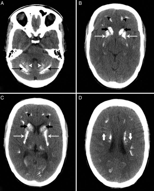 Рис.1. Болезнь Фара (стриопаллидодентатный кальциноз). На нативной КТ в аксиальной плоскости визуализируются двусторонние симметричные участки кальцификации в гемисферах мозжечка (тонкие черные стрелки) (рис.А). Также обратите внимание на кальцификацию обоих зубчатых ядер (головки стрелок) (рис.А). Наблюдается обширная двусторонняя кальцификация в головках хвостатых ядер (толстые черные стрелки) (рис.B и C), скорлупе и латеральных бледных шарах (тонкие белые стрелки) с относительно интактными медиальными отделами бледных шаров и таламуса (рис. B). Также имеется кальцификация на границе серого и белого вещества (черные стрелки) (рис.B). Видно, что линейные участки кальцификации простираются перпендикулярно хвостатым ядрам (толстые белые стрелки) (рис.D).