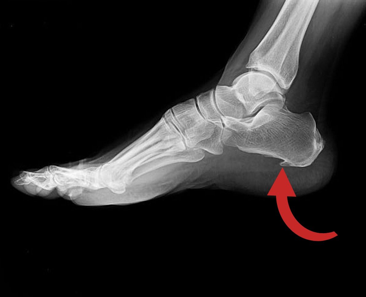 Пяточная шпора – остеофит пяточной кости